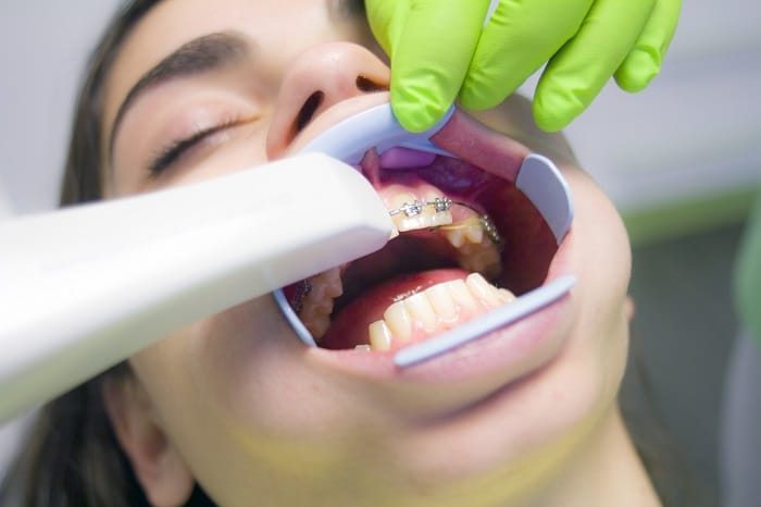 Zahnspangen für Kinder 2023